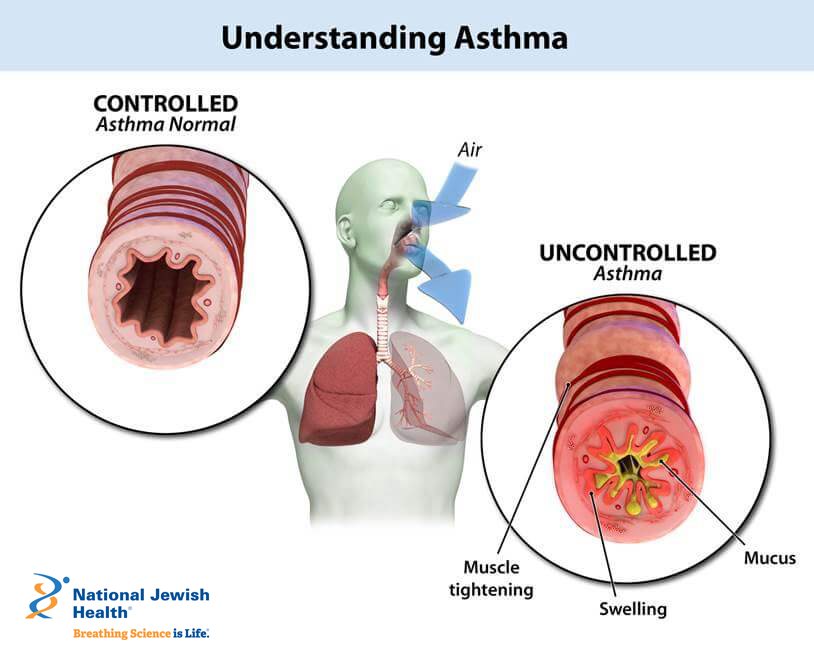 Understanding Asthma