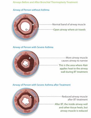 BT airway diagram