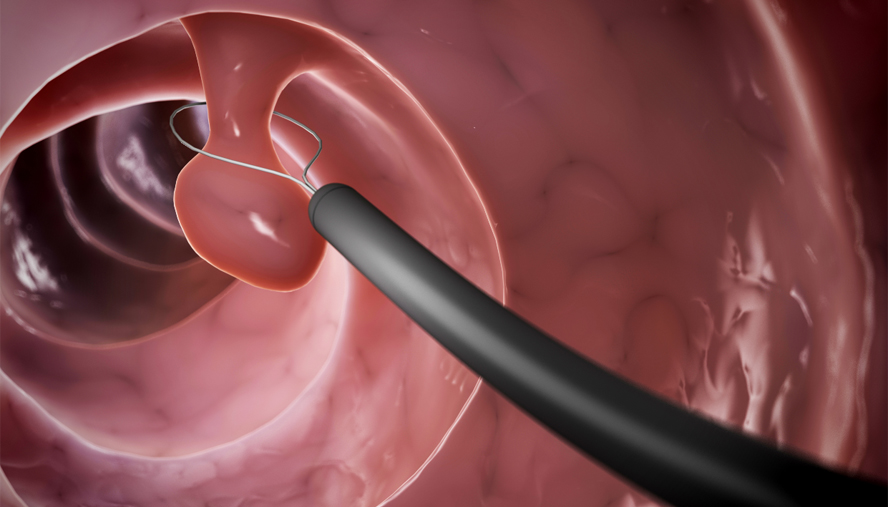 Medical illustration of a colon polyp.