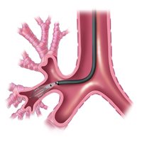 bronchial thermoplasty