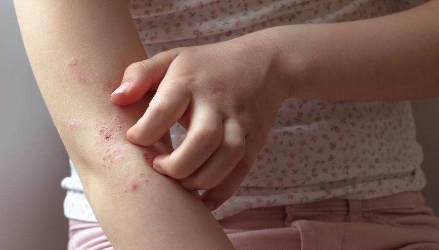 Atopic dermatitis on the arm